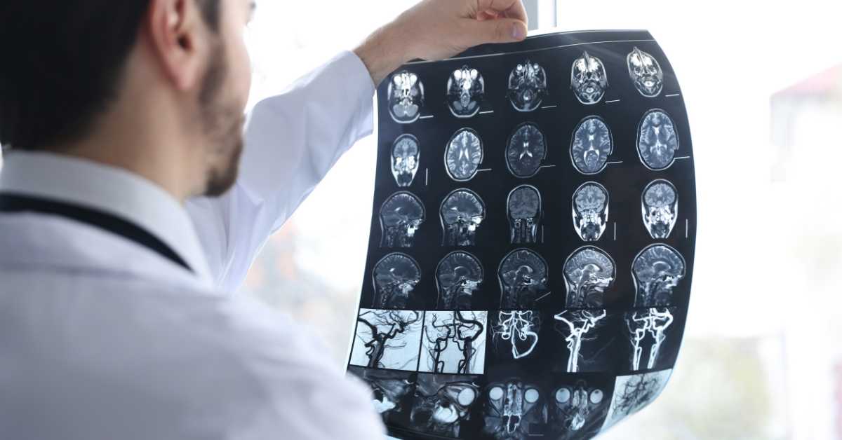 Traumatic Brain Injuries After a Georgia Car Accident: Why TBI Cases Are Often Undervalued